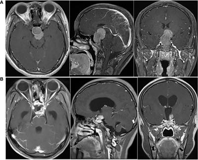 A Pituitary Carcinoma Patient With Cerebrospinal Fluid Dissemination Showing a Good Response to Temozolomide Combined With Whole-Brain and Spinal Cord Radiotherapy: A Case Report and Literature Review